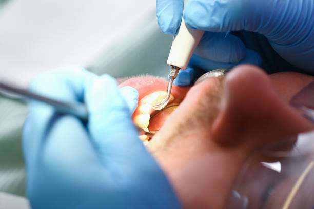 Best Broken or Chipped Tooth Repair in USA